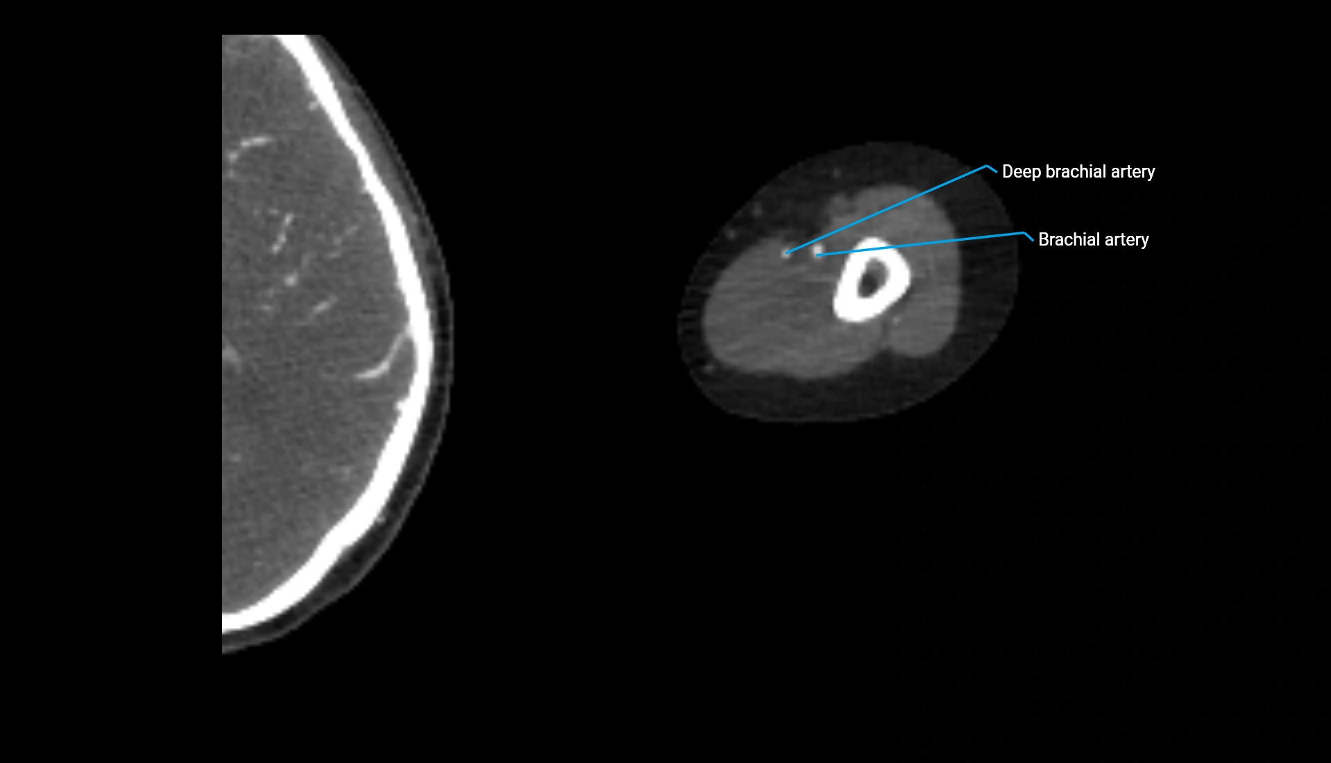CTA upper limb axial cross sectional anatomy labelled image 240 (2).webp